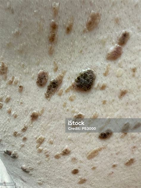Seborrheic Keratosis On Human Skin Stock Photo Download Image Now