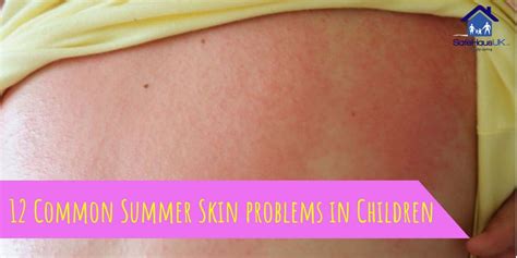 Skin Problems In Children That Common In The Summer