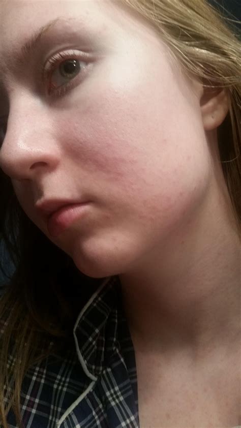 Skin Concerns Weird Rash On Face Neck And Chest Rskincareaddiction