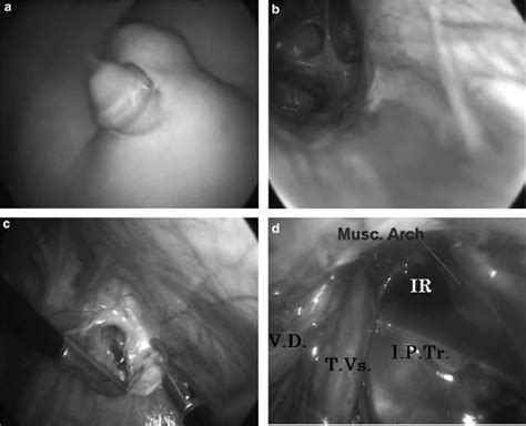 Operative Photographs For Two Cases Of Right Pediatric Inguinal Hernia