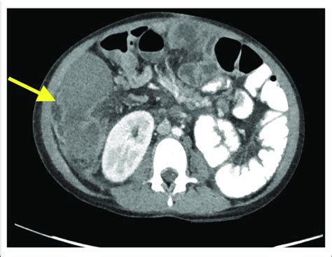 Axial Ct Scan Demonstrating A Right Intra Abdominal Rim Enhancing