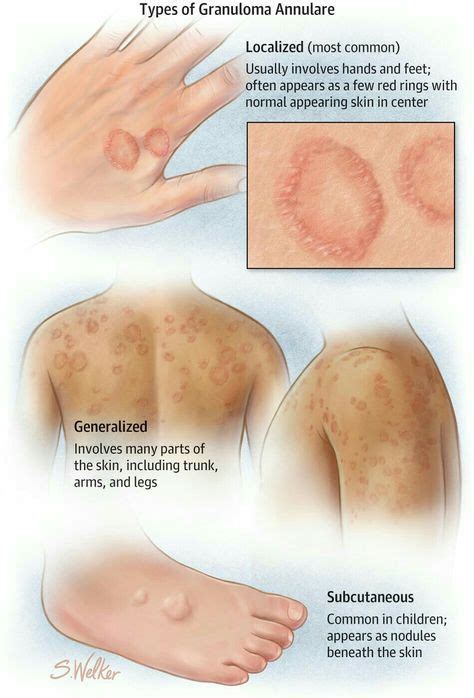 Pin By Lt Aryknk On Dermato Skin Dermatology Nurse Granuloma