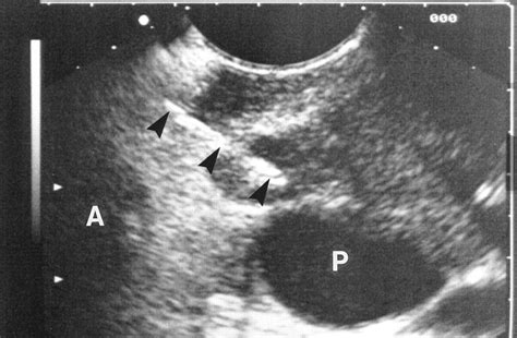 Endoscopic Ultrasound Guided Biopsy Of Mediastinal Lesions Has A Major