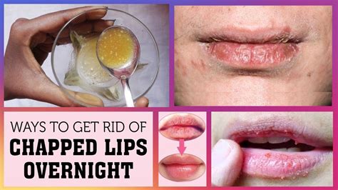 How To Quickly Get Rid Of Dry Lips