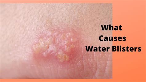What Causes Water Blisters Youtube