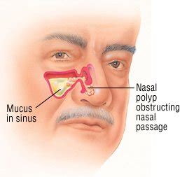 Nasal Polyps Guide Causes Symptoms And Treatment Options