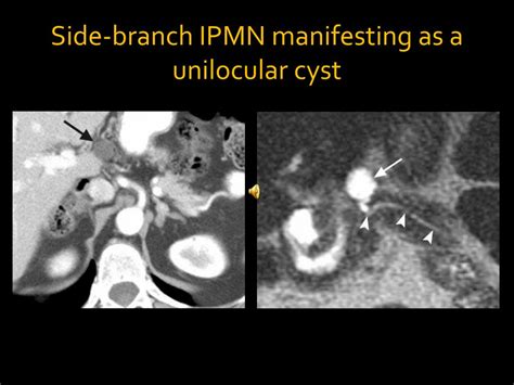 Ppt Imaging Of Pancreatic Cystic Lesions Powerpoint Presentation