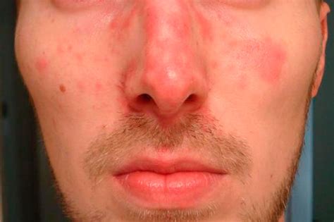 On The Red Spots On The Face After Drinking Alcohol Why There And What To Do