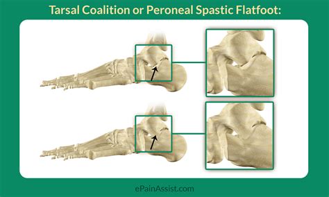 Tarsal Coalition Or Peroneal Spastic Flatfootsignscausesdiagnosis