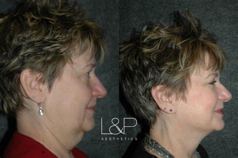 Facelift And Neck Lift Before And After Photos Case 20 Palo Alto And San