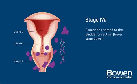 what is cervical cancer cervical cancer explained — bowen icon cancer centre