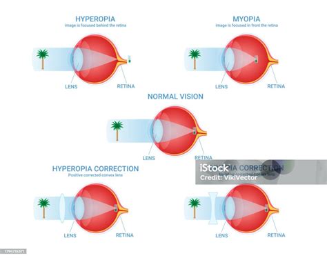 Vision Defects Visual Impairment Normal Myopia Hyperopia Correction