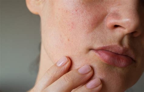How To Keep Your Skin Safe From Toasted Skin Syndrome Healthwire