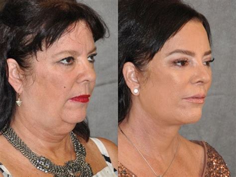 Just Like Kris Jenner S Sister Goes Under The Knife To Look Like Kuwtk Star