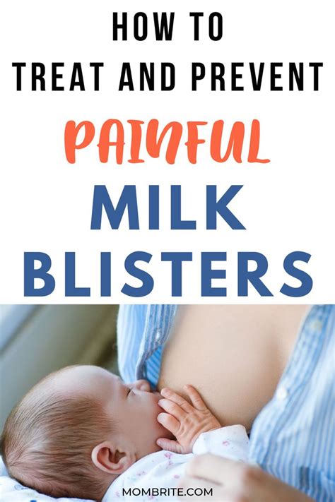 How To Treat And Prevent Milk Blisters Milk Blister Breastfeeding