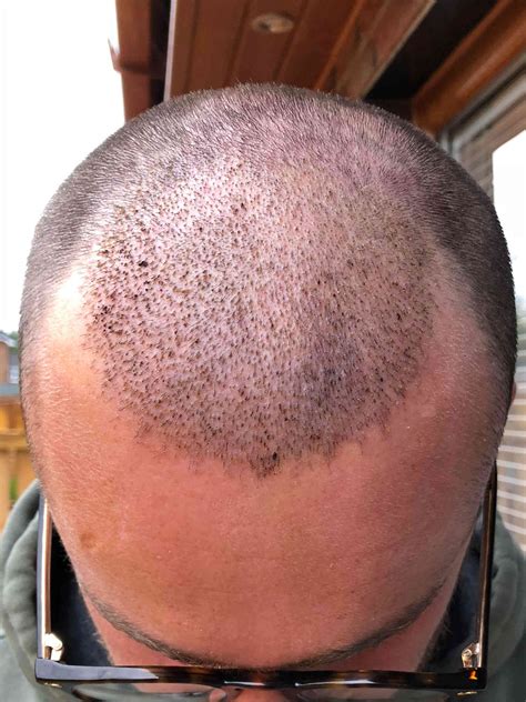 Post Op Recovery Photographs Weeks After Fue Hair Transplant Procedure