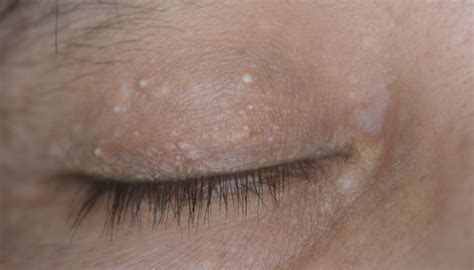 What Are Those Little White Bumps On Your Skin Theyre Milia And Heres What You Can Do