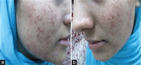 Treatment For Facial Seborrhea Dermatitis Naked Pictures Naked Photo
