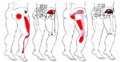 Sciatic Nerve Pain Try This Effective Homemade Remedy