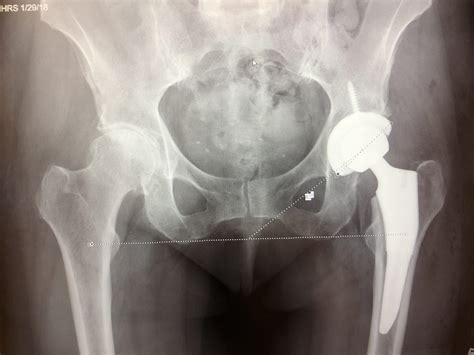 How Safe Is Hip Replacement Surgery