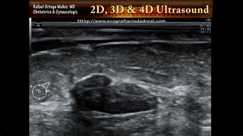 Fribroadenoma Breast Ultrasound 2d And 4d Clinica Ginecologica Dr Rafael