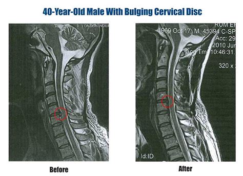 Disc Bulge Treatment In India For Cervical Thoracic Lumbar Disc Bulge