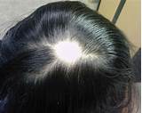 Topical photochemotherapy for alopecia areata. Alopecia areata. Causes, symptoms, treatment Alopecia areata