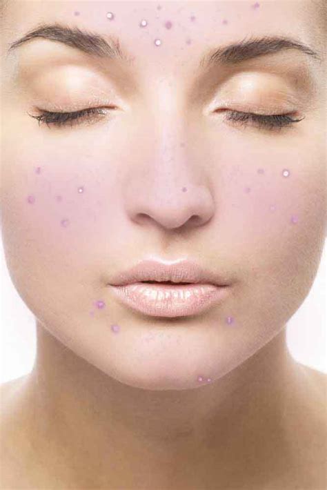 Pulse Guru Facts Related To Acne Prone Skin