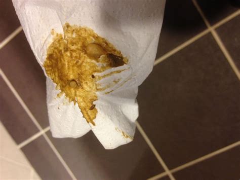 Check spelling or type a new query. Worm cysts (?) on toilet paper On CureZone Image Gallery