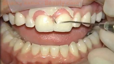 Cosmetic Dentistry - Teeth Bonding & Dental Bonding #1 - YouTube