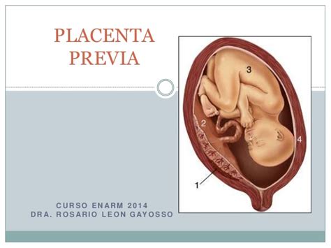 What are they types of placenta previa? Placenta previa