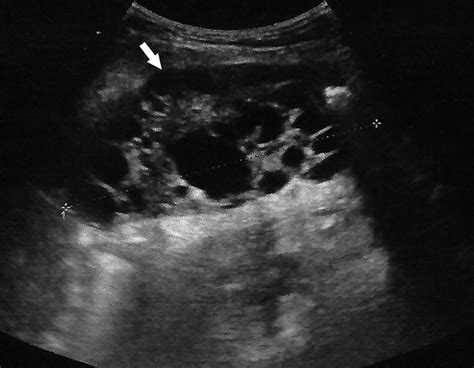 Abdominal Ultrasonography Shows Large Multiloculated Cystic Mass In