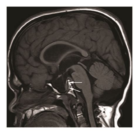 A Cranial Mri Of Case 1 Obtained At The Age Of 8 Years Reveals