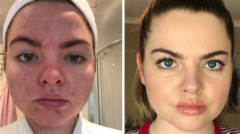 Woman Claims Utan Tanning Water Helped Reduce Her Adult Acne Tyla