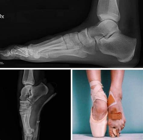 What Does A Ballerinas Foot Look Like On An X Ray Orthopaedic Specialists