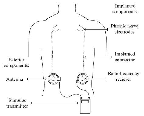 Phrenic Nerve Stimulation From 15 Download Scientific Diagram