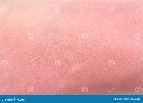 Sunburn Skin Stock Photo Image Of Burns Itching Solar 33277590