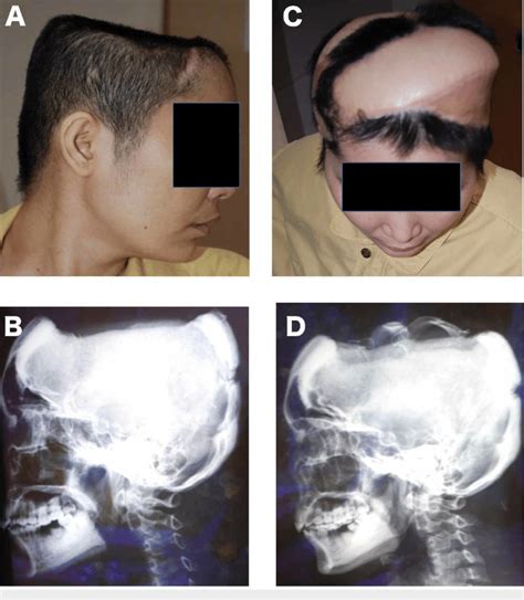 Scalp And Calvarium Reconstruction With Extended Fleur De Lis Ld