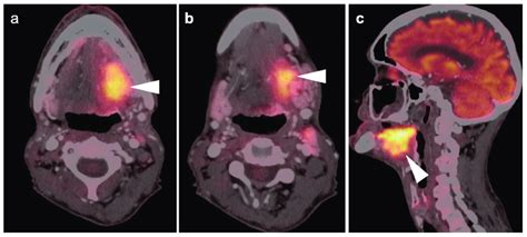 Squamous Cell Carcinoma Of The Oral Tongue On Fdg Pet Ct A