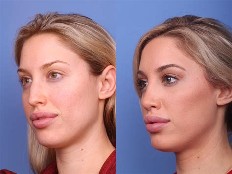 Rhinoplasty Before And After Pictures Case 225 Scottsdale Az