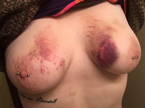 Bruised Tits Tumblr