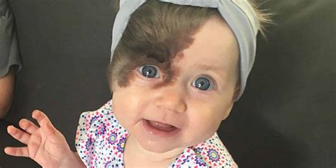 Baby Ruby Has Seven Scheduled Procedures To Remove A Noticeable Hairy