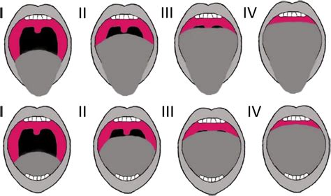 Utility Of The Modified Mallampati Grade And Friedman Tongue Position