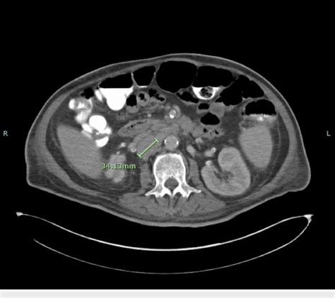 Ct Of The Abdomen And Pelvis Demonstrating Extensive Retroperitoneal
