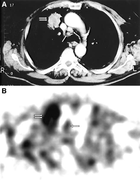 Mediastinal Lymph Node Involvement In Nonsmall Cell Lung Cancer