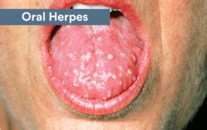 The Full Breakdown On Oral Stds Types Symptoms And Treatment