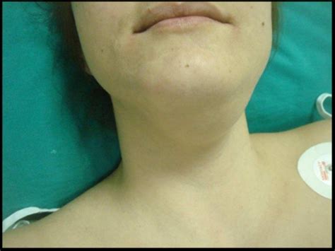 The 35 Year Old Female Presented With A Submandibular Left Sided Neck