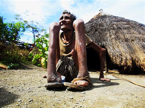 Leprosy is India's secret epidemic, says report - CBS News