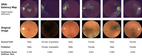 Predicting Sex From Retinal Fundus Photographs Using Automated Deep Learning No Flux