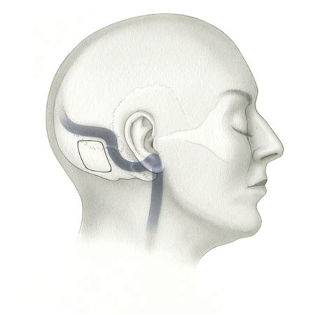 Retrosigmoid Approach Skull Base Surgery Atlas